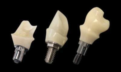 طول تاج ایمپلنت دندانی بهینه سازی شد/ افزایش استحکام